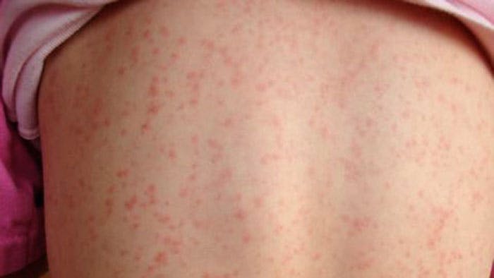 Cover Image for Scarlet fever is back and parents need to watch out for these signs and symptoms