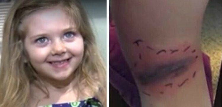 Cover Image for Mom Sends Warning to All Parents After a Small Bruise on Back of Her Daughter’s Knee Ends in a Trip to E.R.