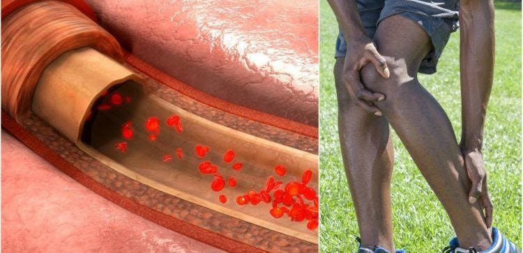Cover Image for 9 Red Flags That Could Mean You're Experiencing a Blood Clot