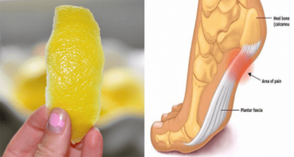 Cover Image for A Peel Of Lemon Can Remove Joint Pain Forever