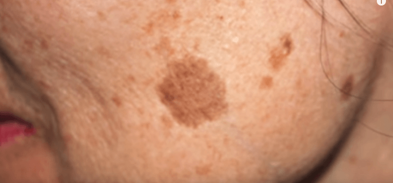 Cover Image for Simple Trick to Remove Brown Spots from Your Skin