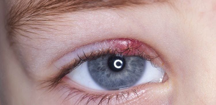 Cover Image for If You Wake Up and Your Eye Looks Like This, Here Are 11 Remedies You Should Know